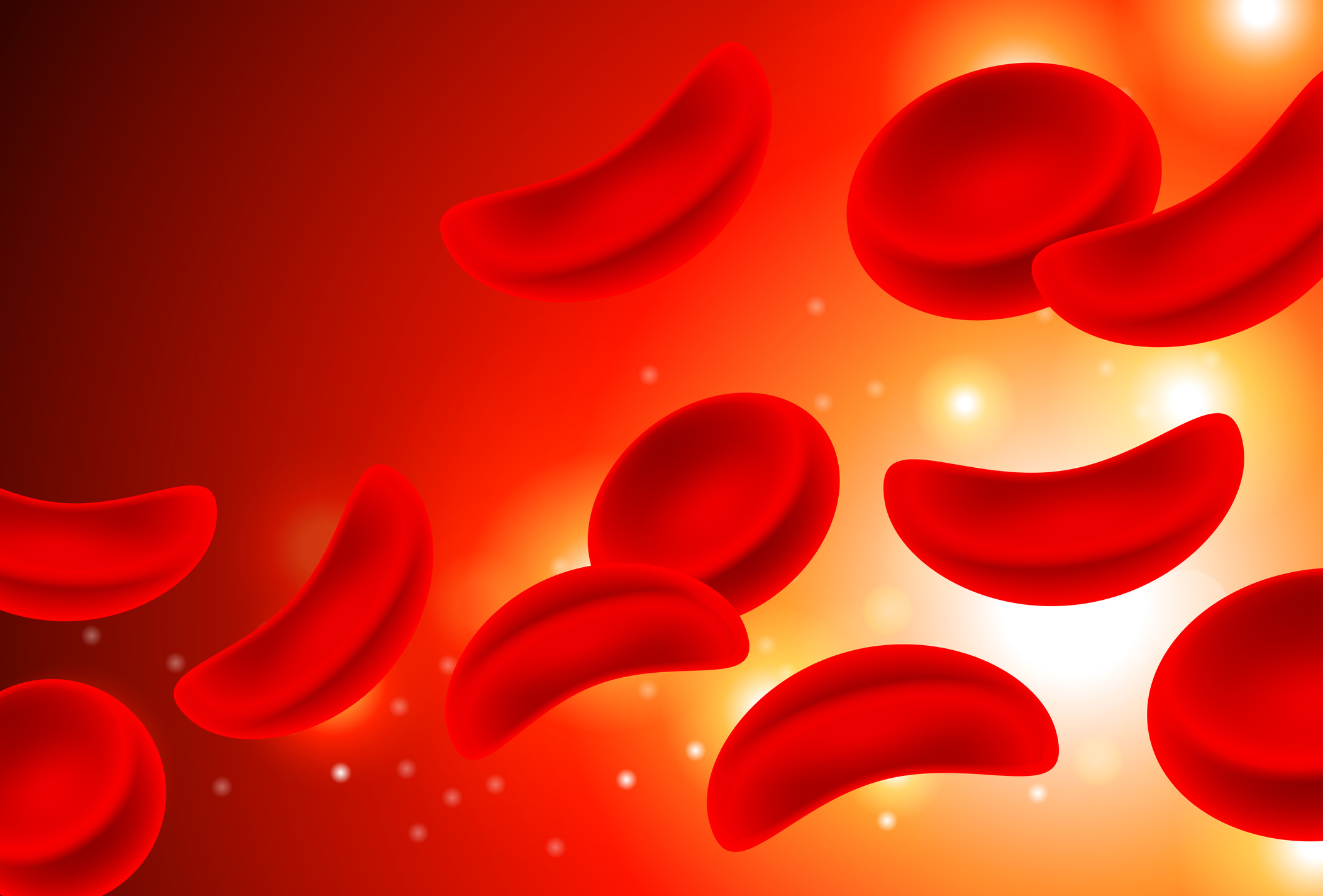 Sickle Cell Anemia Red cells in Blood Stream